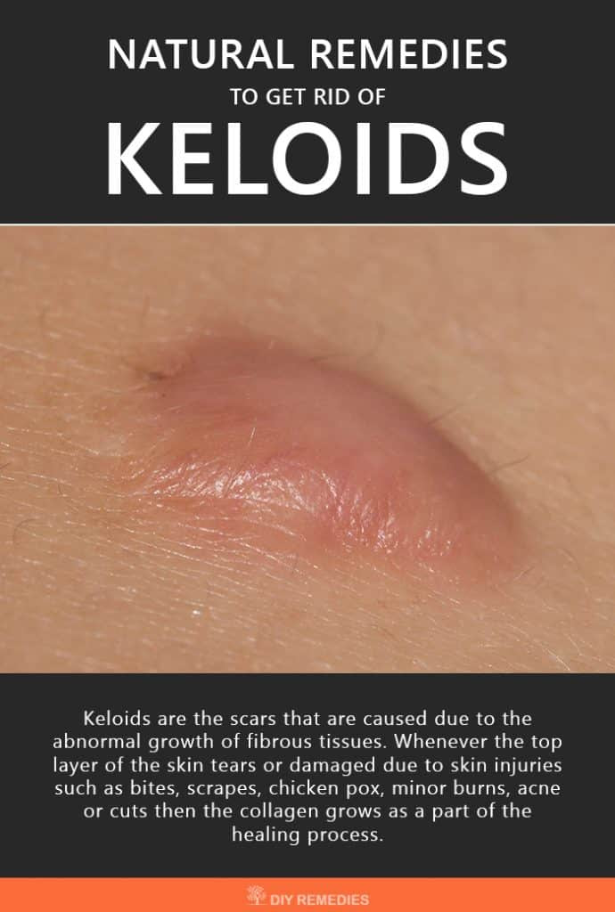 Natural Remedies to Get Rid of Keloids