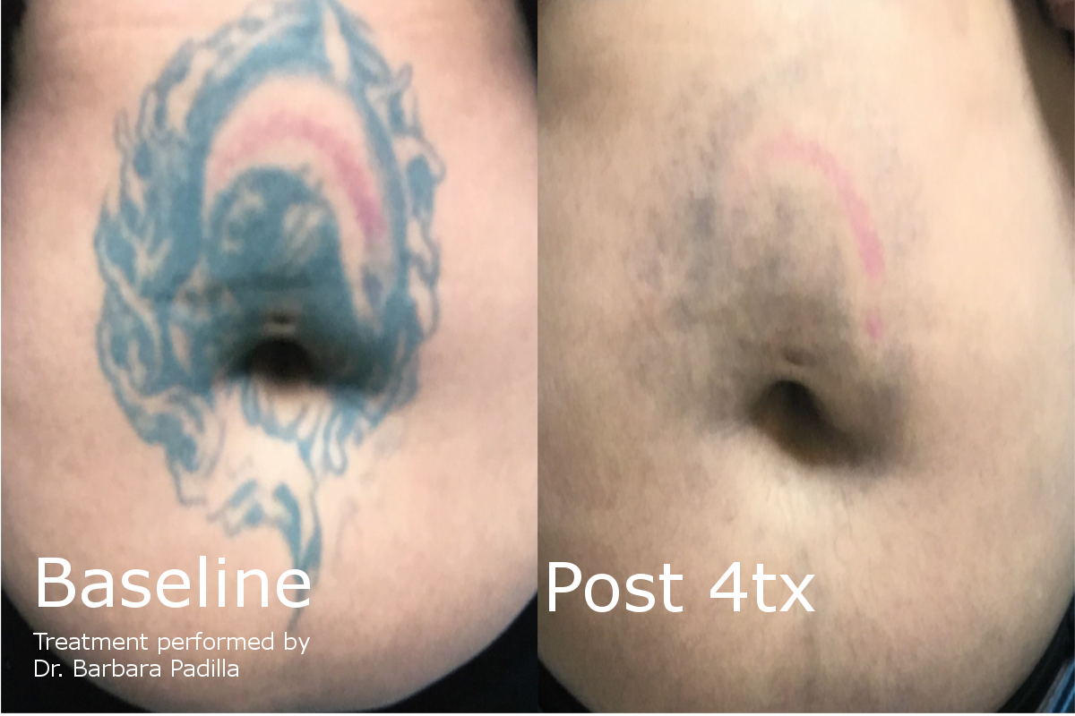 Laser Tattoo Removal | Enlighten™| Latest and Most ...
