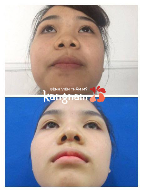 thu gọn cánh mũi không phẫu thuật-3