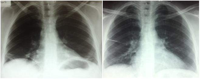 Shrinking Lung Syndrome In Systemic Lupus Erythematosus Department Of Internal Medicine La Rabta University Hospital