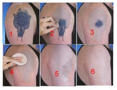 tattoo-removal-cream | Tattoo Love
