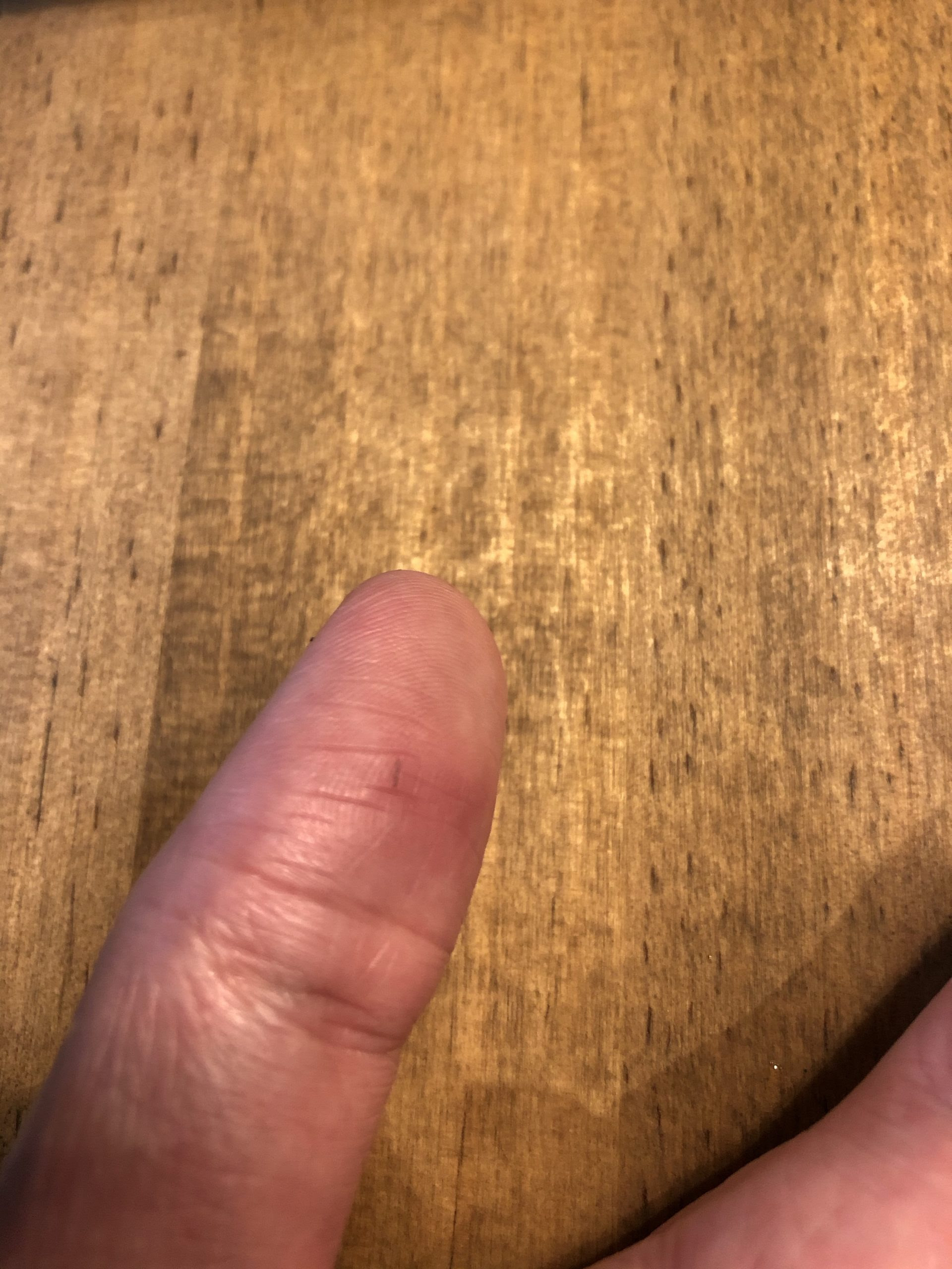 髪の毛が指 皮膚 に刺さった時の対処方法 Nikul Com