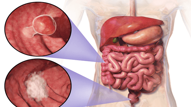 نتيجة بحث الصور عن ‪Turmeric is able to inhibit colon cancer‬‏