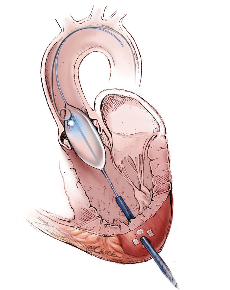Illustrated techniques for transapical aortic valve ...