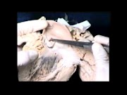 19 VSD Spontaneous Closure