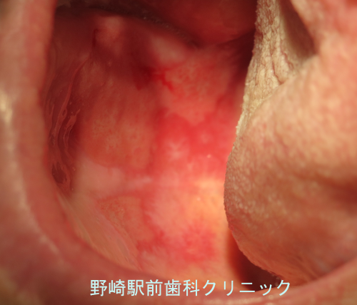 口腔カンジダ症例 大東市 野崎駅前歯科クリニック 治療大解説