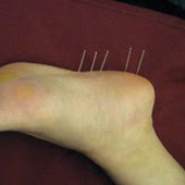 足根管症候群の治療専門 足根管症候群の治療なら中国鍼灸院