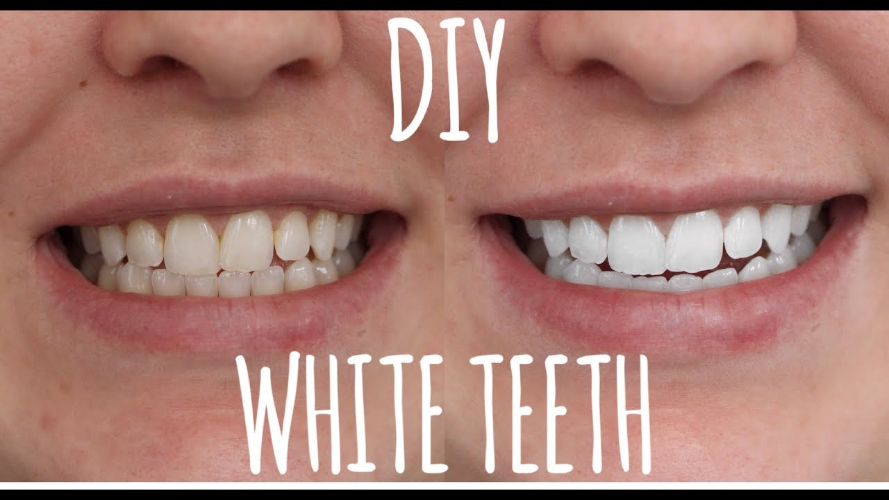 Teeth Whitening for Smokers - Dental Health Society