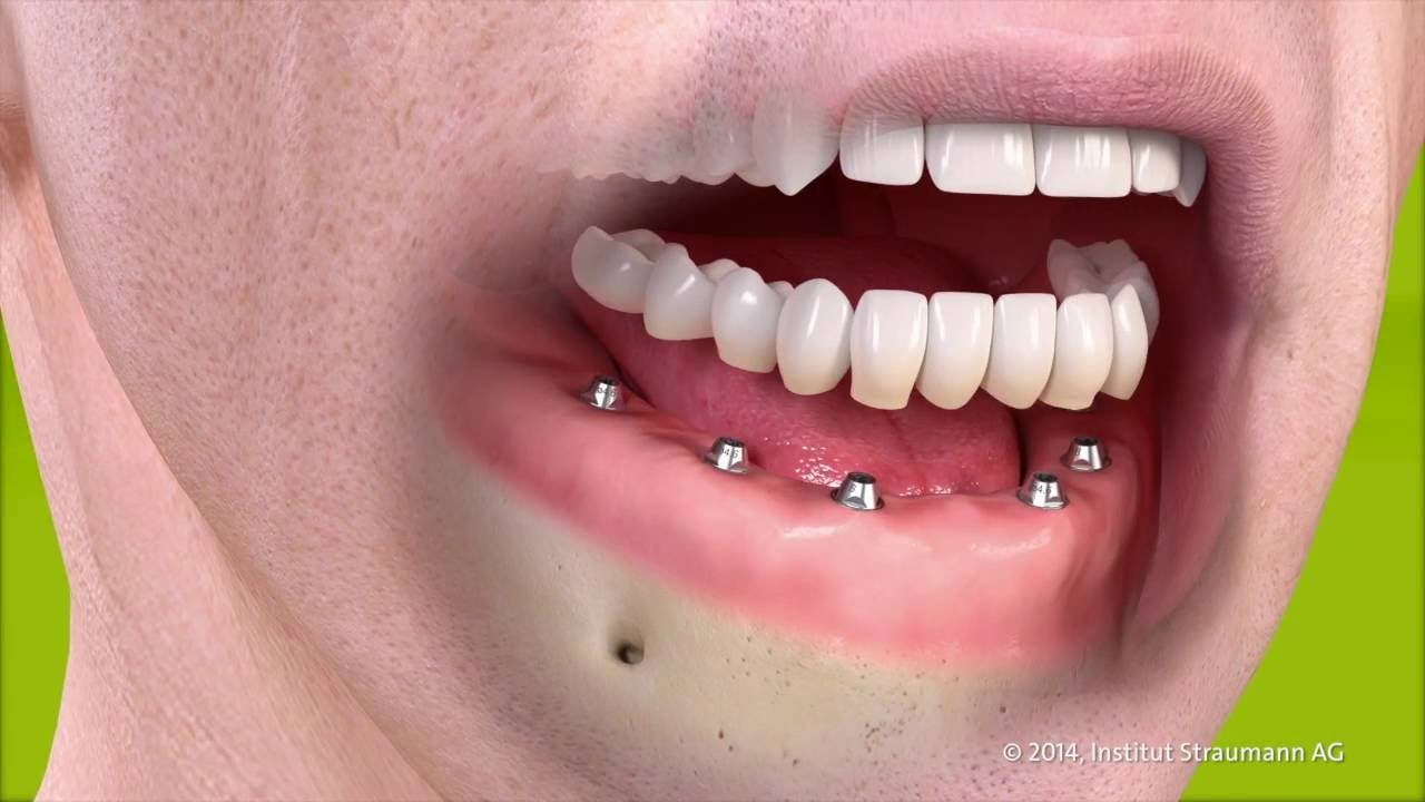 Dental Implants Procedure, Cost, Types, Problems Safe