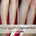 How To Get Rid Of Ingrown Hair Scars On Legs