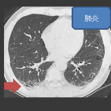 胸部CT検査 | 呼吸器の検査 | 各検査を知る | 人間ドック | 健診会 東京メディカルクリニック