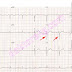 Sokolov Criteria / Telemetry Technician Course: EKG Criteria for Left ... : So too, he is eccentric in his stage manner.