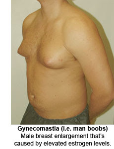 gynecomastia