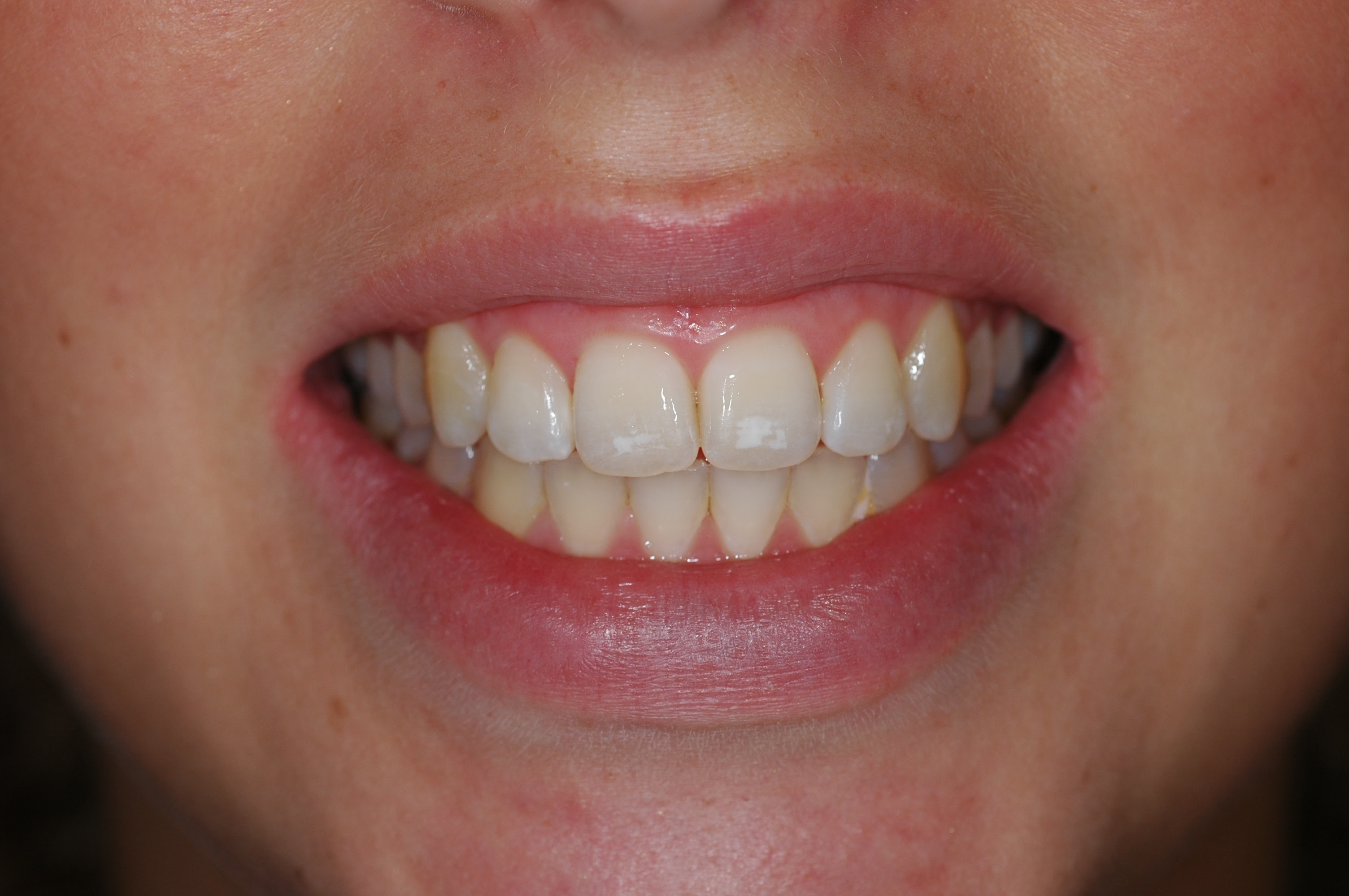 Teeth http://myteethnvd.wordpress.com/2010/12/19/white-spots-on-my