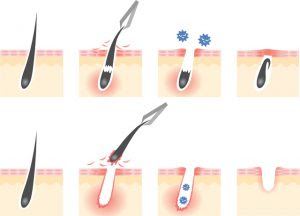 髭を抜くときに守るべき３つのこと メンズ脱毛チャンネル