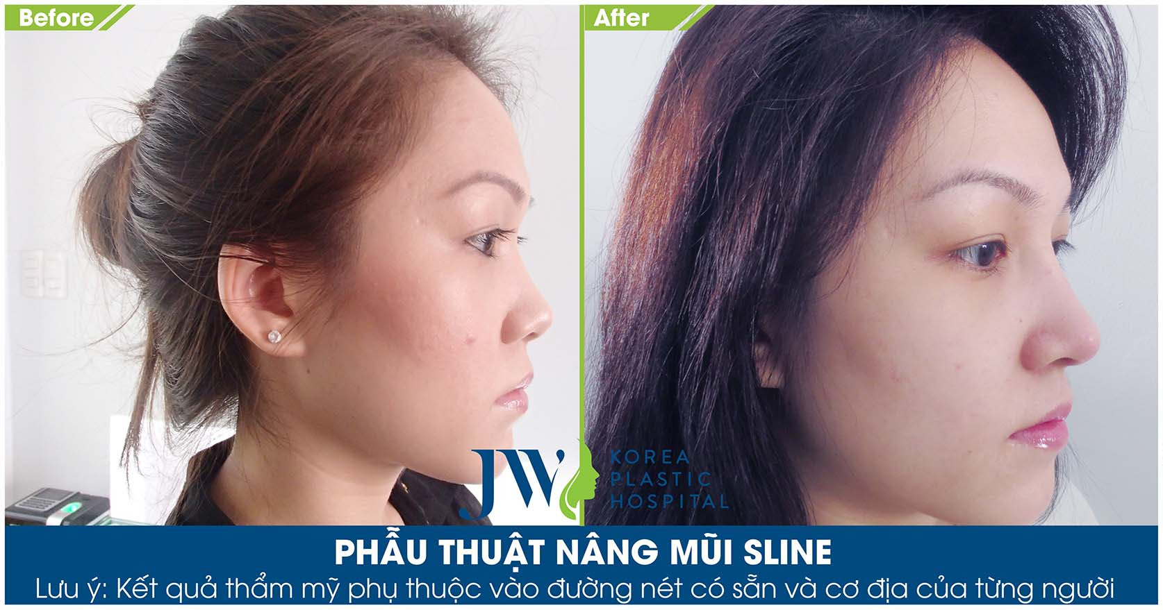 Nâng mũi uy tín tại Sài Gòn