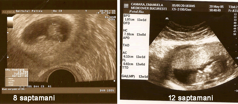 Ecografii Cu Bebelusii Nostri Sarcina Pe Trimestre