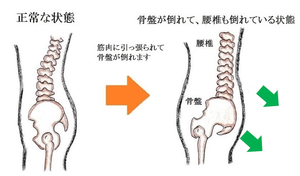 疲労骨折 腰椎分離症 アスリートゴリラ鍼灸接骨院 旧高林はりきゅう接骨院