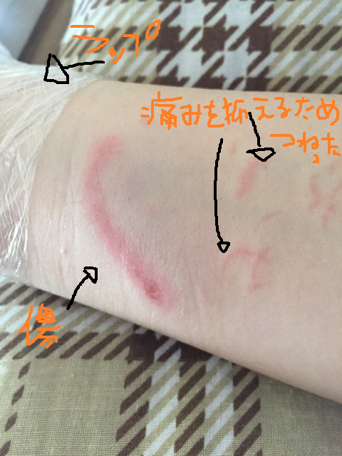 ショック 愛犬に噛まれたら 医師から聞いた正しい対処法 そして これから愛犬とどう向き合えばいい ぶりっこ旦那とでっぱ虫の役立つコツコツ生活