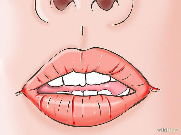 Các bệnh - Không tham ăn mà vẫn bị chốc mép: Lời cảnh báo từ cơ thể (Hình 2).