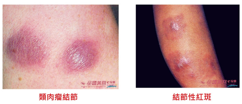 常見皮膚病 膿皰和結節 全國美容雜誌社