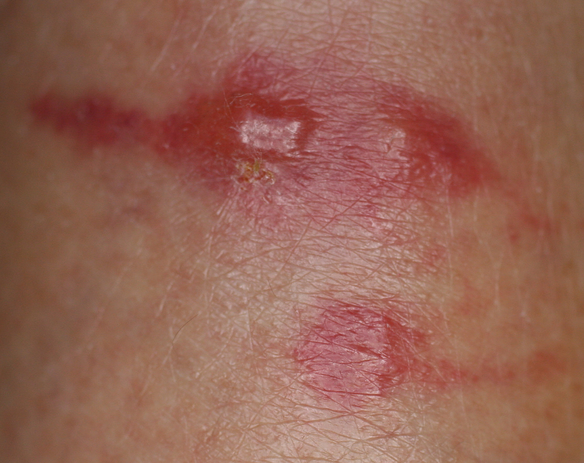 虫刺症ちゅうししょう 虫刺され