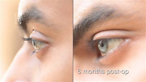 eye color change surgery cost colorpaintsco