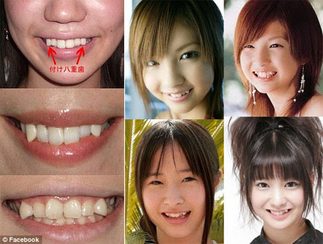 có nên mài răng nanh cho đều không