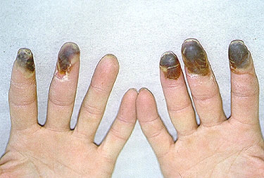 Gambar Kemasan Rokok Harus Menakutkan