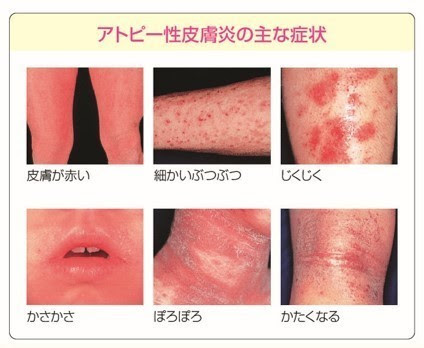 アトピー性皮膚炎 韮崎市の皮膚科 美容皮膚科ならさおり皮ふ科クリニック