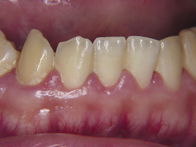 むし歯 歯周病 歯周病 舩坂歯科医院 静岡県浜松市中区 自由診療専門歯科医院