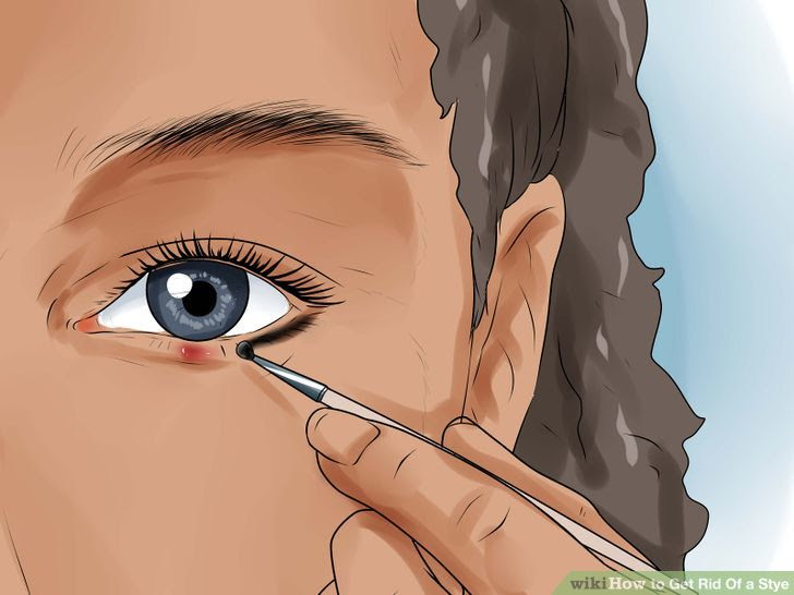 Get Rid of a Stye Step 11 Version 3.jpg
