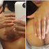 Graphic Photos : See What Happened To This Woman Br**st After Implant