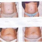 Fotos da lipoaspiração