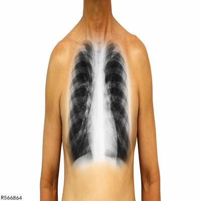 肋骨骨折起床技巧肋骨骨折如何护理 疾病 快速问医生 有问必答