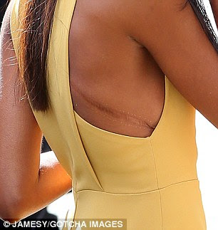 Mark: Naomie's dress revealed what appeared to be a surgical scar