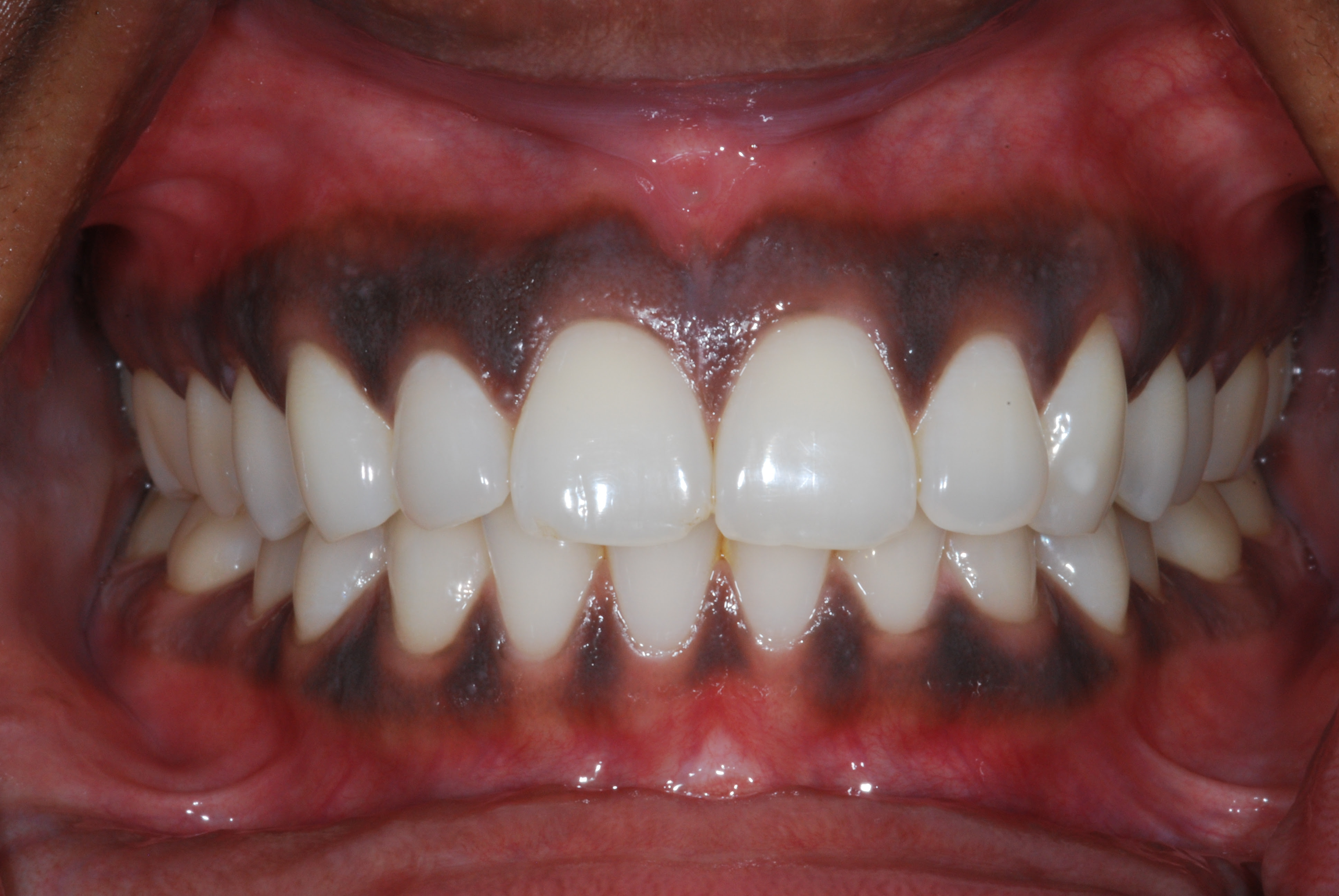 Gum Bleaching – Is it for you? | Dental Implants ...