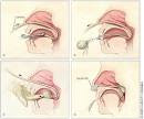Management of EPISTAXIS - January 15, 2005 - American Family Physician