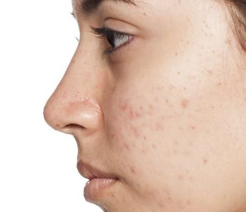 Como Cuidar El Acne En El Embarazo