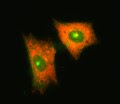 lung most cancers level iib