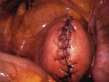 inomyoma