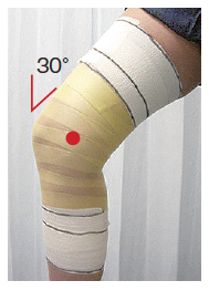 膝の内側側副靱帯損傷 上手なテーピングの巻き方 飯島整形外科 ドクター飯島のスポーツ医学ｑ A