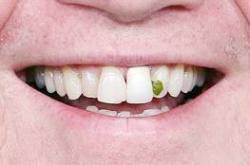 Researchers Suggest You Might Not Need to Floss After All! Here’s Why.