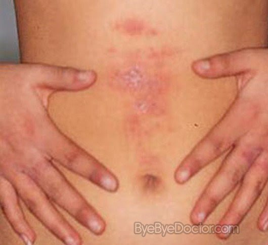 fungal rash pictures 3