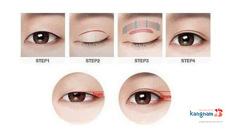 phẫu thuật thẩm mỹ mắt 4