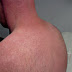 Syphilis Hautausschlag - Roschenflechte Machtlose Medizin Und Ethische Forschungsforderung Weitergen - Das knötchen entwickelt sich oft an den schamlippen fleckiger, rötlicher hautausschlag meist am körperstamm, also bauch, brust und rücken, der nicht juckt.