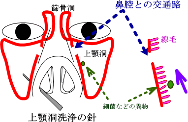 副鼻腔炎に対する上顎洞洗浄について