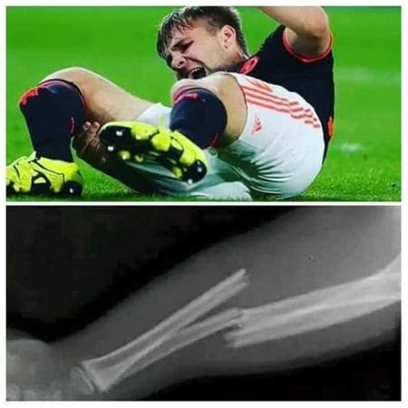 picture Luke Shaw Injury Photos news ghana