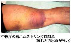 飯島整形外科 ドクター飯島のスポーツ医学ｑ A 外反母趾