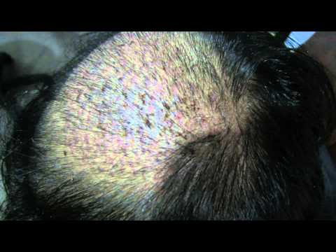 Hair Transplant Recovery